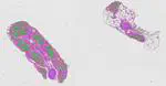 Spatial transcriptomics CIAP human sural nerve