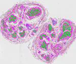 Spatial transcriptomics CIAP human sural nerve