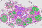 Spatial transcriptomics healthy human sural nerve